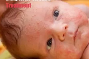 Baby Acne on Face