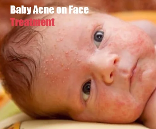 Baby Acne on Face
