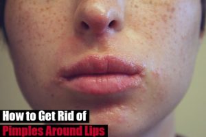 Pimples Around Lips