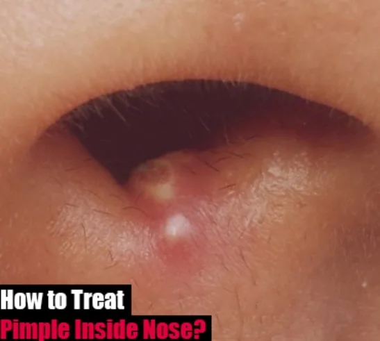 Pimple Inside Nose