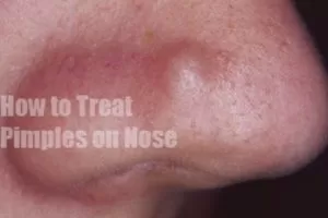 Pimples on Nose