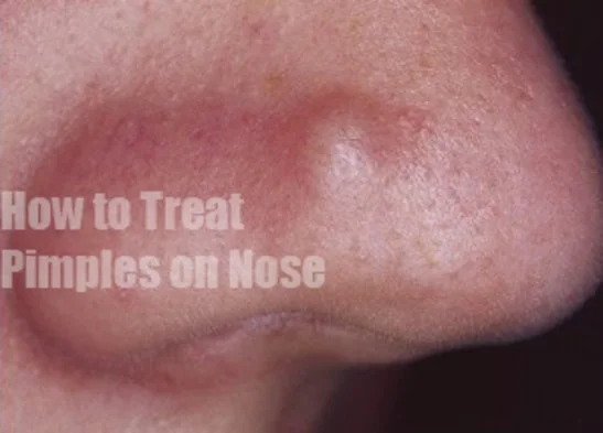 Pimples on Nose