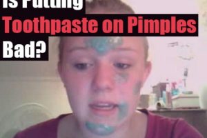 Toothpaste on Pimples
