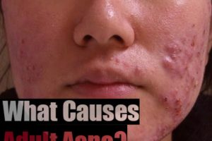 What Causes Adult Acne