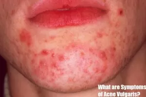 Symptoms of Acne Vulgaris