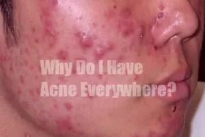 Acne Everywhere