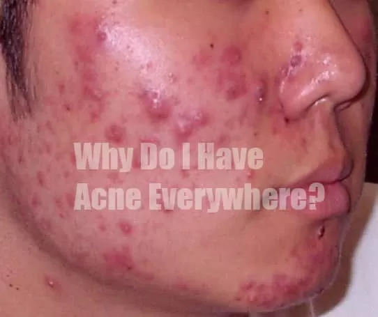 Acne Everywhere