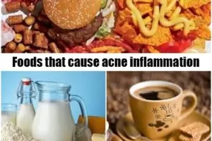 Foods that cause acne