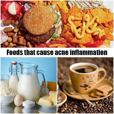 Foods that cause acne