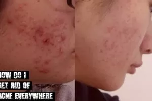 Get Rid of Acne Everywhere