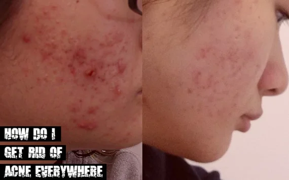 Get Rid of Acne Everywhere