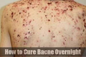 Cure Bacne Overnight