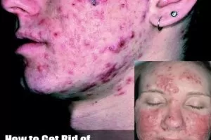 Acne All Over Face