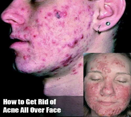 Acne All Over Face