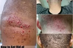 Acne on Back of Neck