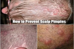 Scalp Pimples