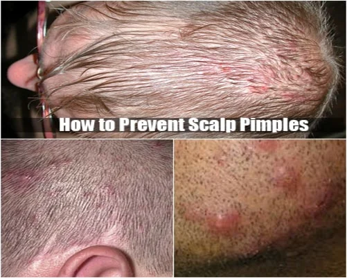 Scalp Pimples