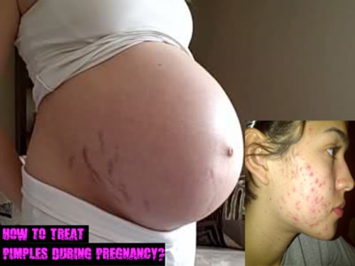 Pimples During Pregnancy