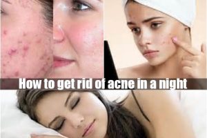How to get rid of acne in a night