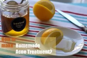 Homemade Acne Treatment