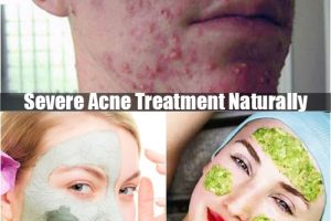 Severe acne treatment naturally