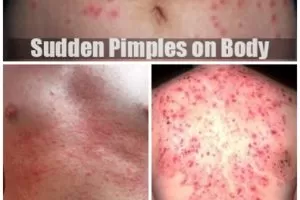 Sudden Pimples on Body