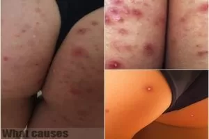 pimples on butt