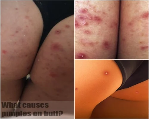 pimples on butt