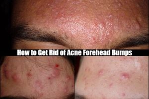 acne forehead bumps