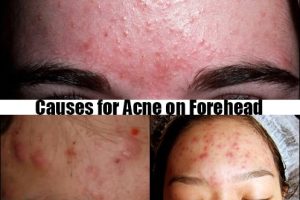 Causes for Acne on Forehead