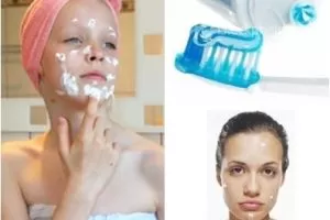 putting toothpaste on acne