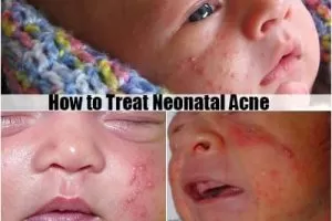 neonatal acne
