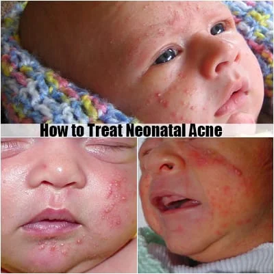 neonatal acne