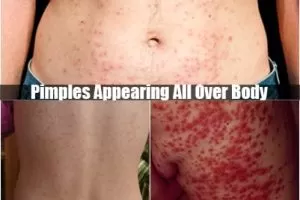 pimples appearing all over body