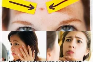 acne quiz