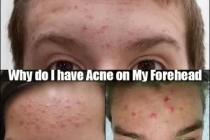 acne on my forehead