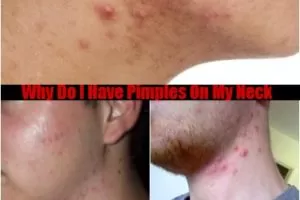 pimples on my neck