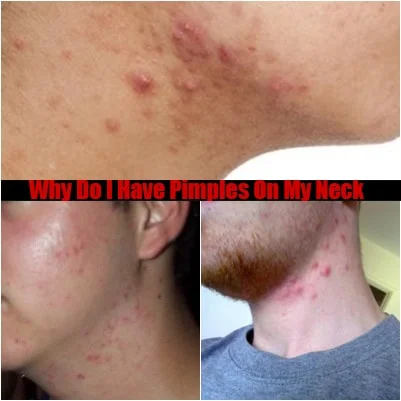 pimples on my neck