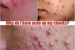 acne on my cheeks