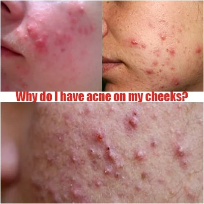 acne on my cheeks