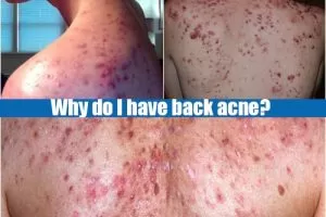 Why do I have back acne