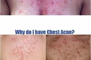 why do I have chest acne