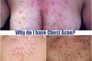 Why do I have chest acne