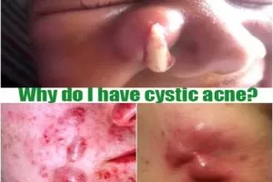 Why do I have cystic acne