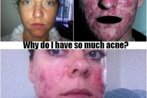 so much acne