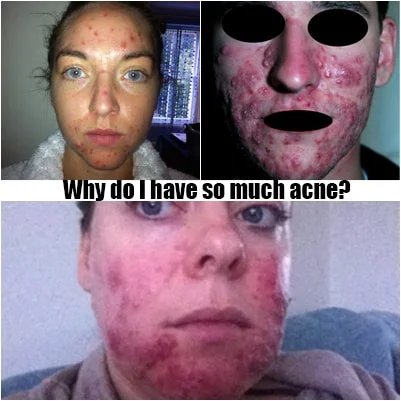 so much acne