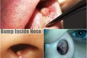 bump inside nose