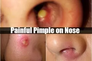 painful pimple on nose