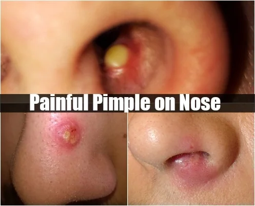 painful pimple on nose