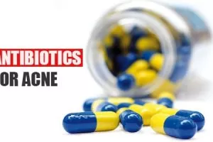 Antibiotics for Acne